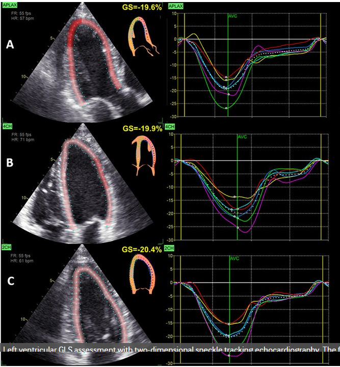 Speckle Tracking Echocardiography - an overview